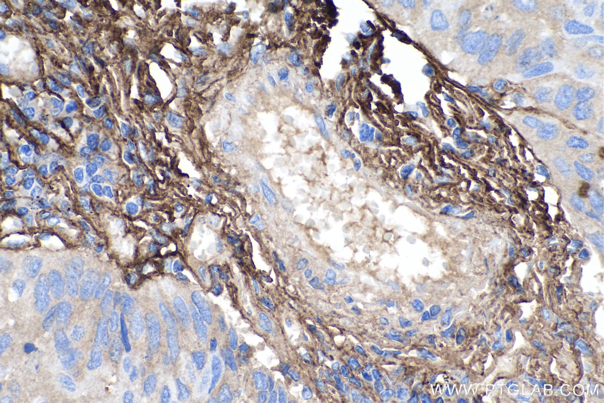 Immunohistochemistry (IHC) staining of human lung cancer tissue using Periostin Polyclonal antibody (27794-1-AP)