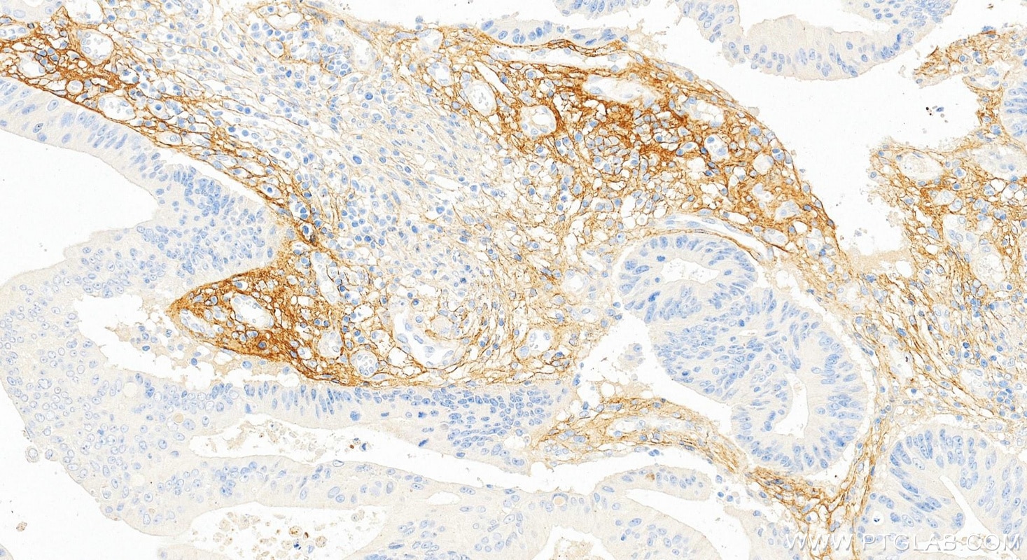 Immunohistochemistry (IHC) staining of human colon cancer tissue using Periostin Monoclonal antibody (66491-1-Ig)