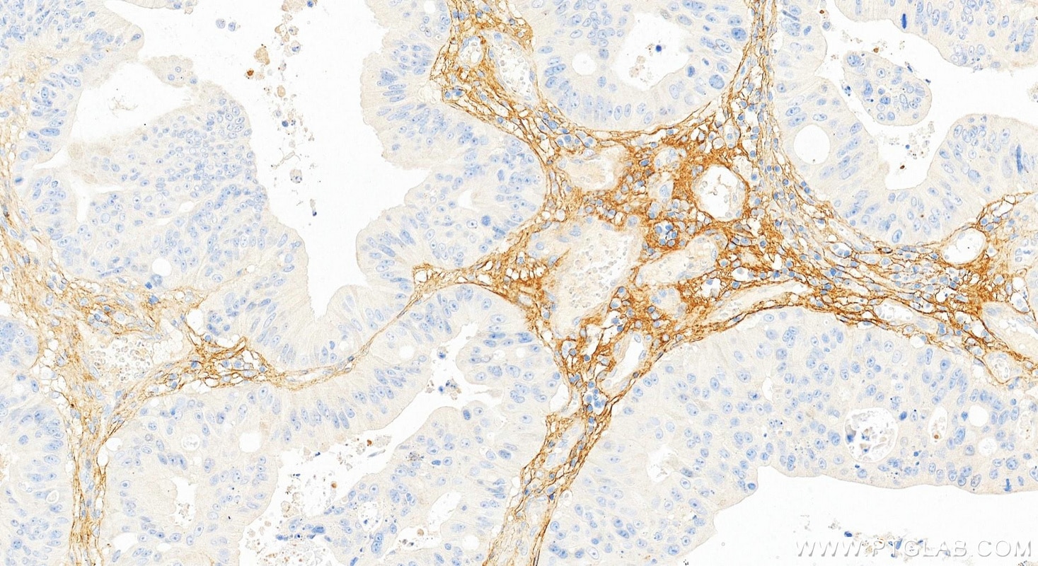Immunohistochemistry (IHC) staining of human colon cancer tissue using Periostin Monoclonal antibody (66491-1-Ig)