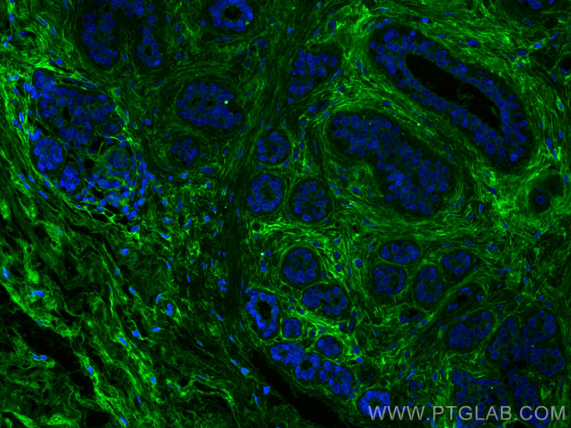 Immunofluorescence (IF) / fluorescent staining of human breast cancer tissue using Periostin Monoclonal antibody (66491-1-Ig)