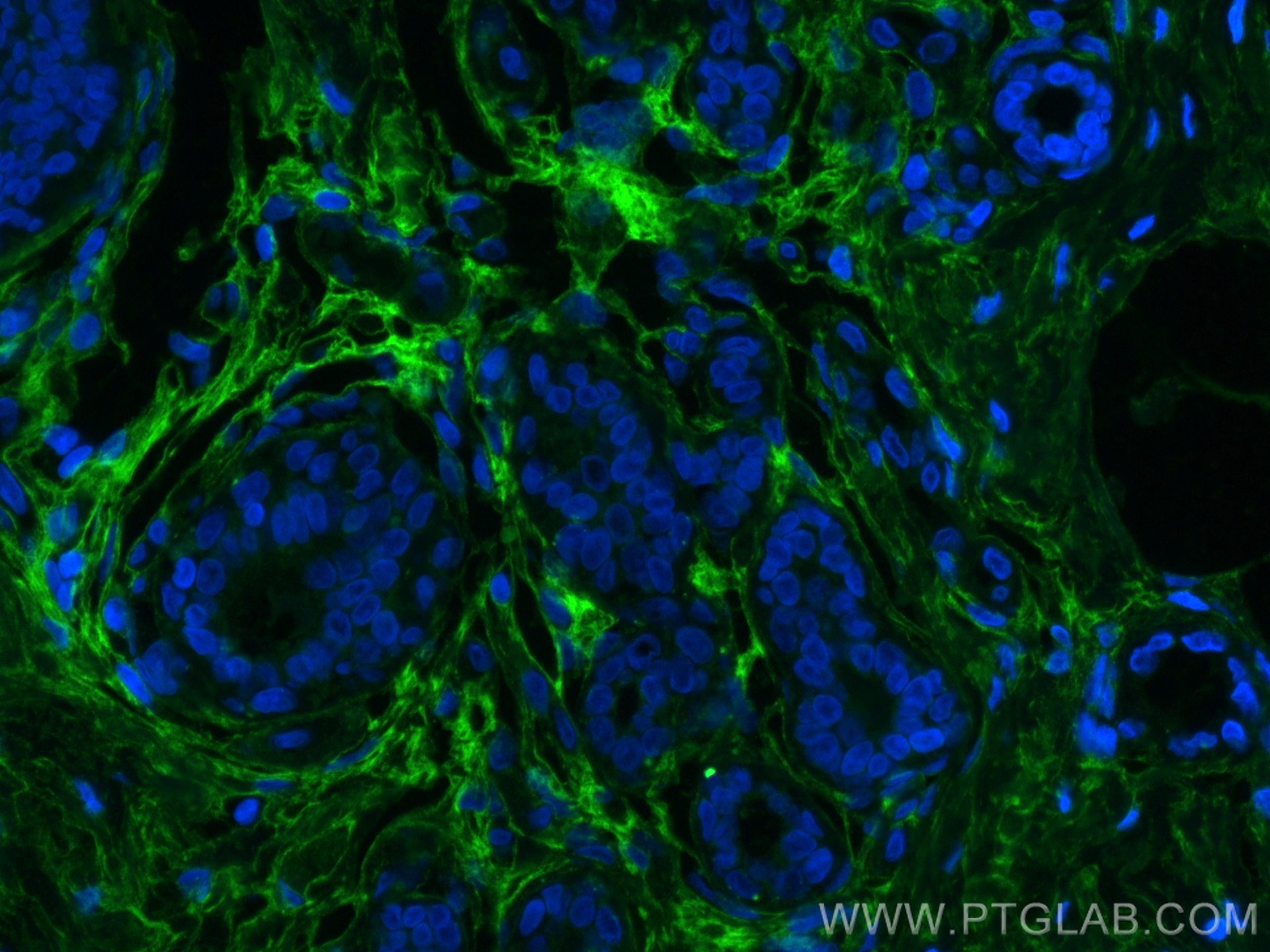 Immunofluorescence (IF) / fluorescent staining of human breast cancer tissue using Periostin Monoclonal antibody (66491-1-Ig)