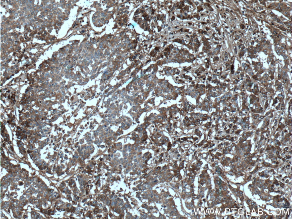 Immunohistochemistry (IHC) staining of human colon cancer tissue using Periostin Monoclonal antibody (66491-1-Ig)