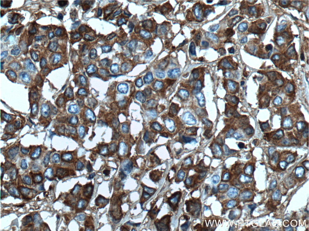 Immunohistochemistry (IHC) staining of human colon cancer tissue using Periostin Monoclonal antibody (66491-1-Ig)