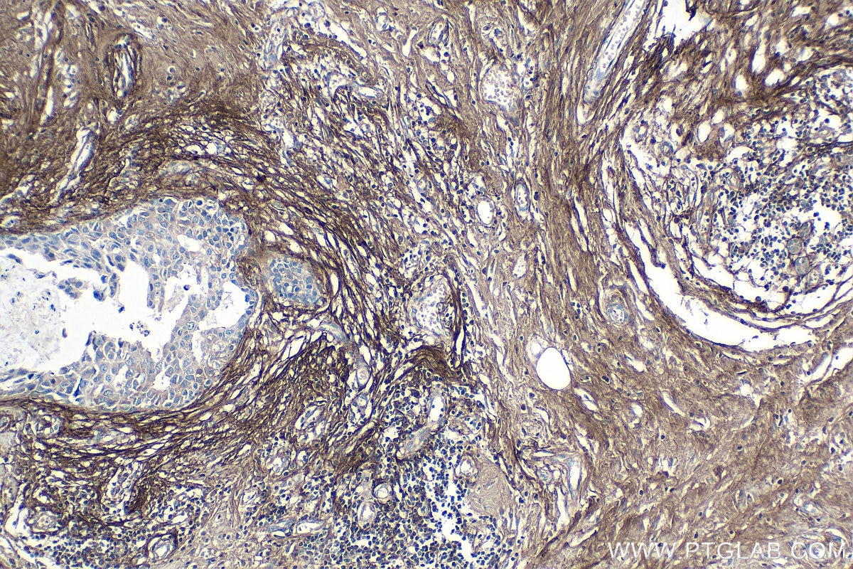 Immunohistochemistry (IHC) staining of human breast cancer tissue using Periostin Monoclonal antibody (66491-1-Ig)