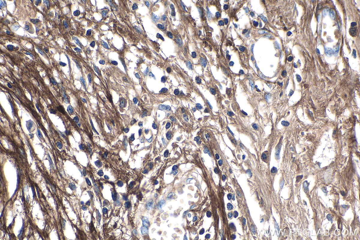 Immunohistochemistry (IHC) staining of human breast cancer tissue using Periostin Monoclonal antibody (66491-1-Ig)