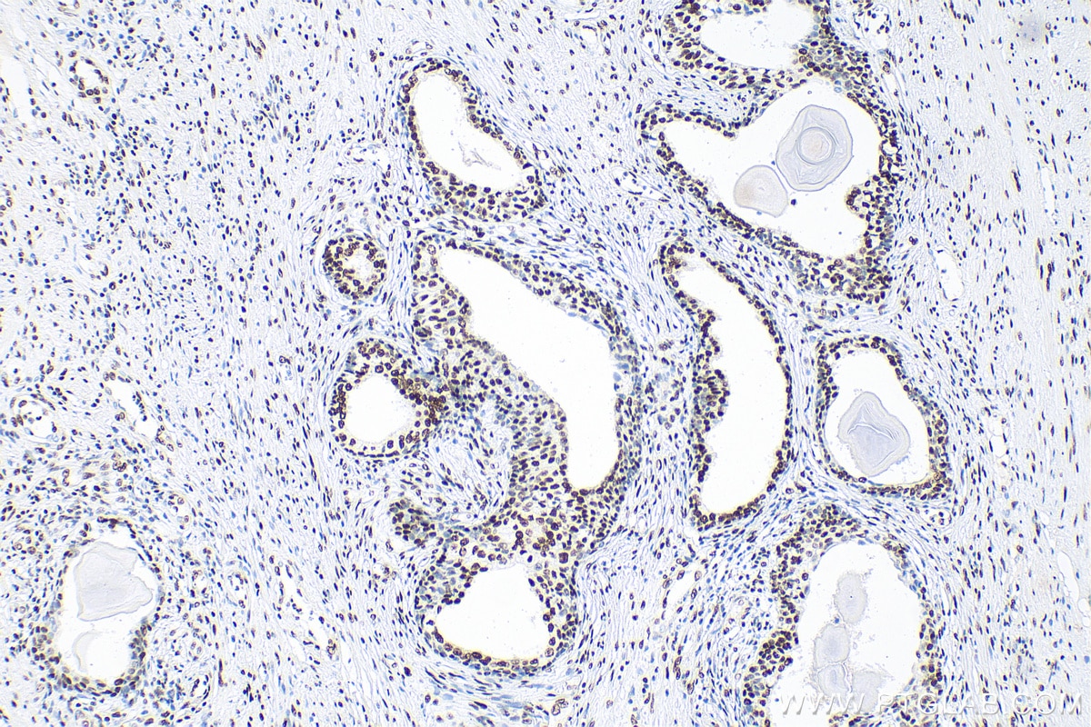 Immunohistochemistry (IHC) staining of human prostate cancer tissue using Phospho-CREB1 (Ser133) Recombinant antibody (81871-1-RR)