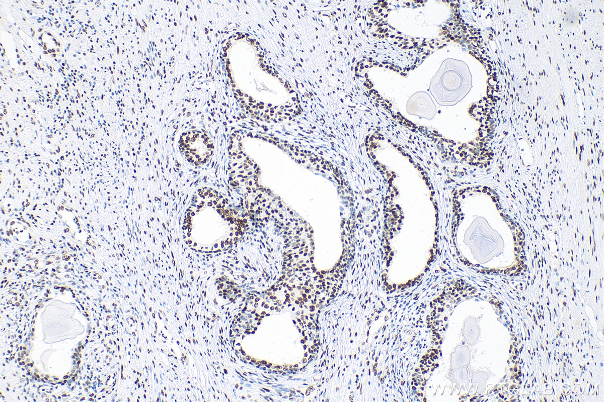 IHC staining of human prostate cancer using 81871-1-RR