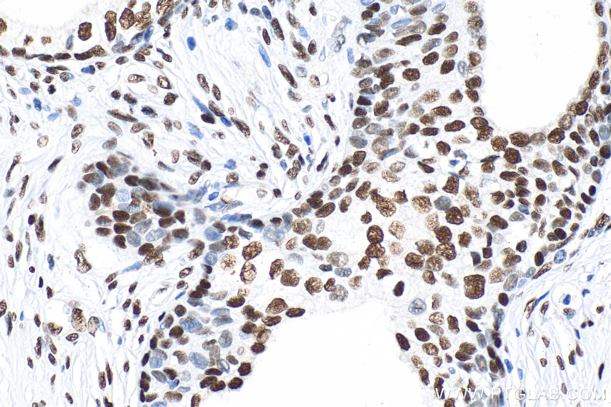 Immunohistochemistry (IHC) staining of human prostate cancer tissue using Phospho-CREB1 (Ser133) Recombinant antibody (81871-1-RR)
