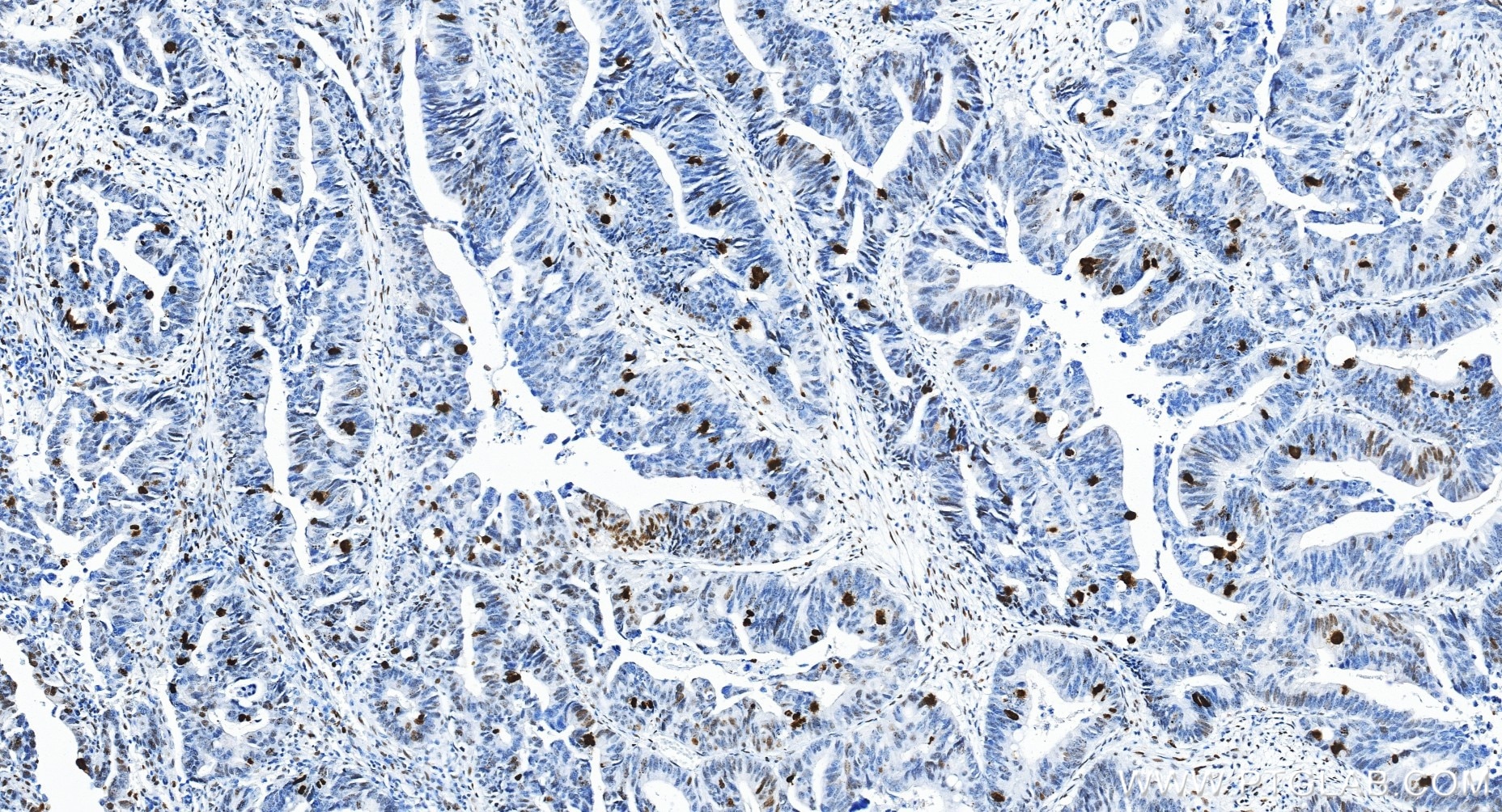 Immunohistochemical analysis of paraffin-embedded human colon cancer tissue slide using 82828-10-RR (Phospho-Histone H3 (Ser10) antibody) at dilution of 1:20000 (under 20x lens). Heat mediated antigen retrieval with Tris-EDTA buffer (pH 9.0). Immunohistochemistry (IHC) staining of human colon cancer tissue using Phospho-Histone H3 (Ser10) Recombinant monoclonal (82828-10-RR)