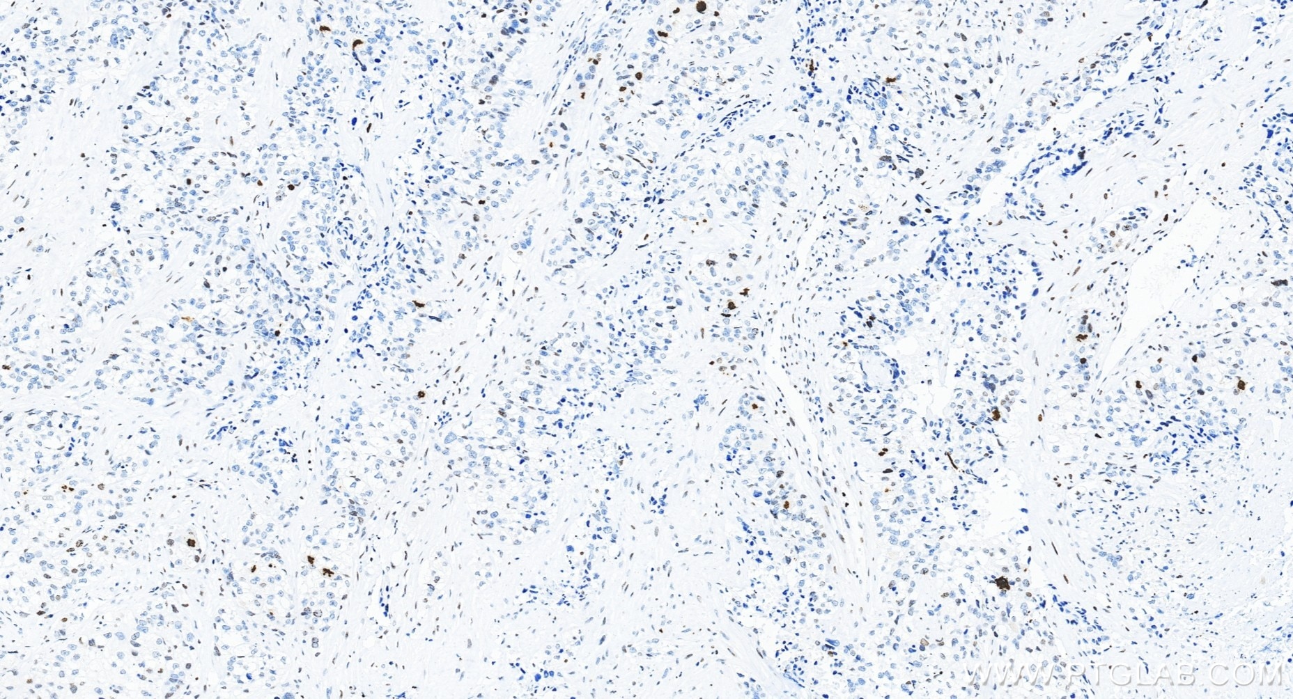 Immunohistochemical analysis of paraffin-embedded human ovary cancer tissue slide using 82828-10-RR (Phospho-Histone H3 (Ser10) antibody) at dilution of 1:20000 (under 20x lens). Heat mediated antigen retrieval with Tris-EDTA buffer (pH 9.0). Immunohistochemistry (IHC) staining of human ovary cancer tissue using Phospho-Histone H3 (Ser10) Recombinant monoclonal (82828-10-RR)