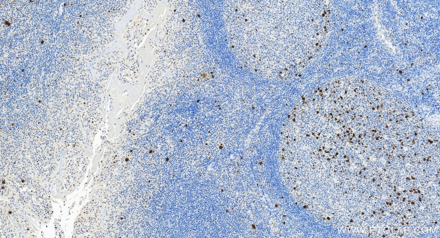 Immunohistochemical analysis of paraffin-embedded human tonsillitis tissue slide using 82828-10-RR (Phospho-Histone H3 (Ser10) antibody) at dilution of 1:4000 (under 20x lens). Heat mediated antigen retrieval with Tris-EDTA buffer (pH 9.0). Immunohistochemistry (IHC) staining of human tonsillitis tissue using Phospho-Histone H3 (Ser10) Recombinant monoclonal (82828-10-RR)