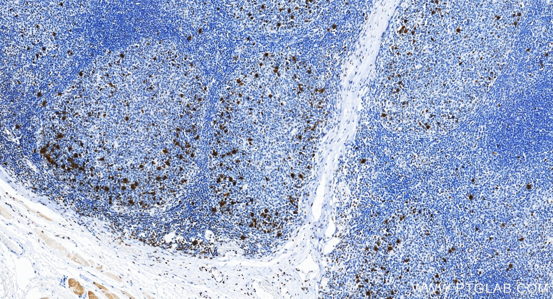 Immunohistochemical analysis of paraffin-embedded human tonsillitis tissue slide using 82828-10-RR (Phospho-Histone H3 (Ser10) antibody) at dilution of 1:20000 (under 20x lens). Heat mediated antigen retrieval with Tris-EDTA buffer (pH 9.0). Immunohistochemistry (IHC) staining of human tonsillitis tissue using Phospho-Histone H3 (Ser10) Recombinant monoclonal (82828-10-RR)