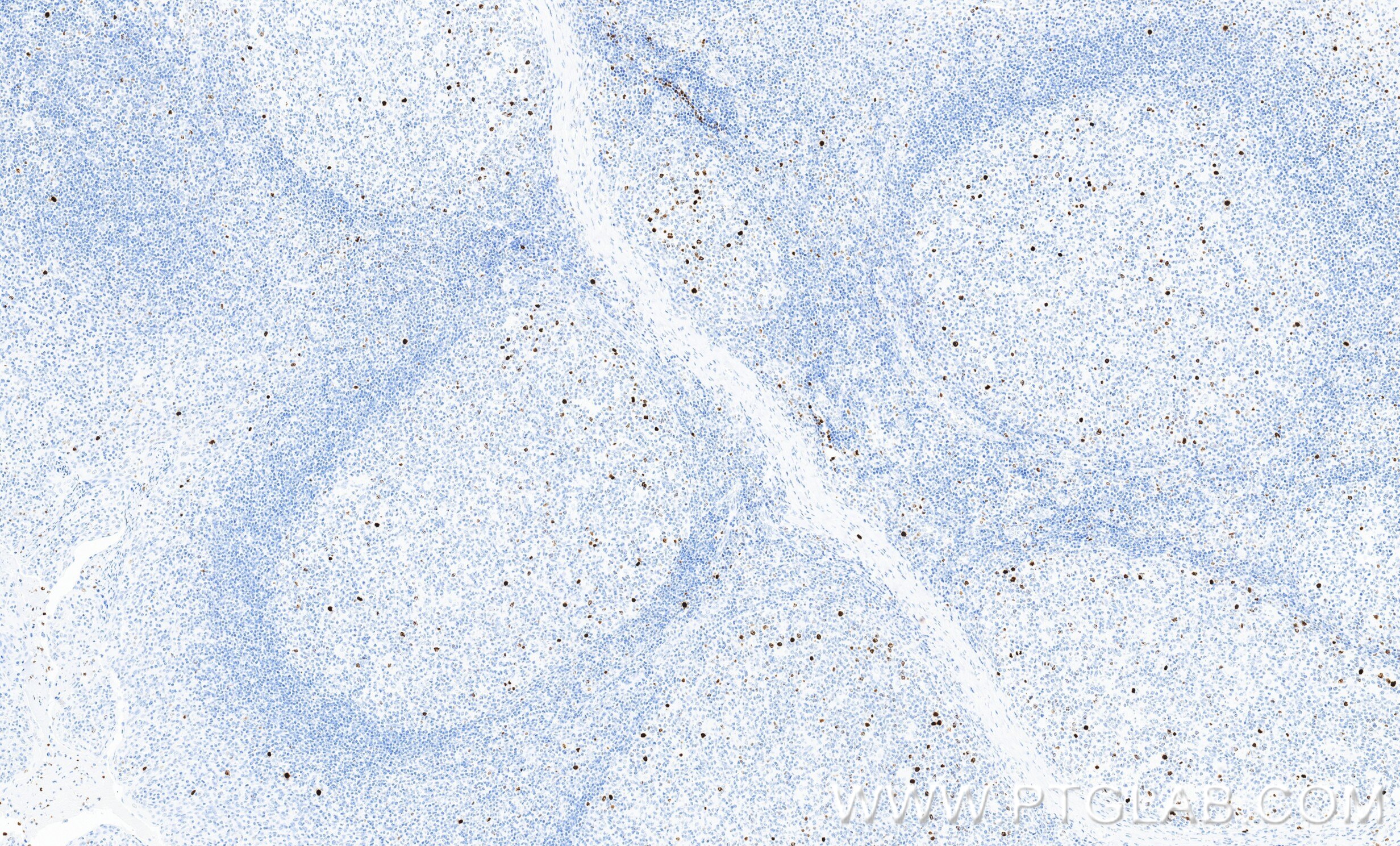 IHC staining of human tonsillitis using 82828-16-RR Immunohistochemistry (IHC) staining of human tonsillitis tissue using Phospho-Histone H3 (Ser10) Recombinant monoclonal (82828-16-RR)