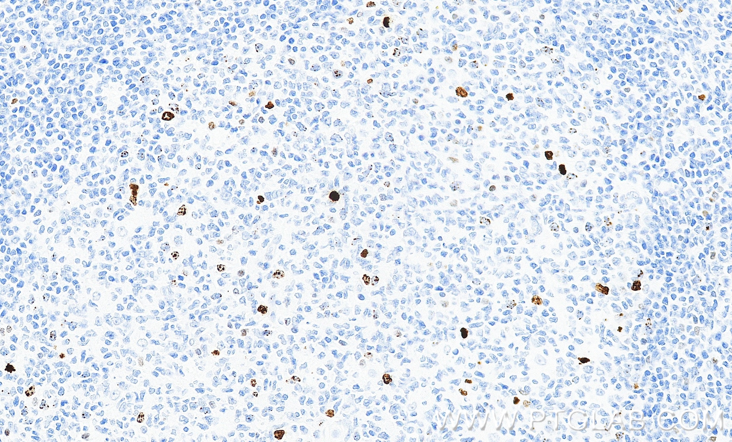 IHC staining of human tonsillitis using 82828-16-RR Immunohistochemistry (IHC) staining of human tonsillitis tissue using Phospho-Histone H3 (Ser10) Recombinant monoclonal (82828-16-RR)