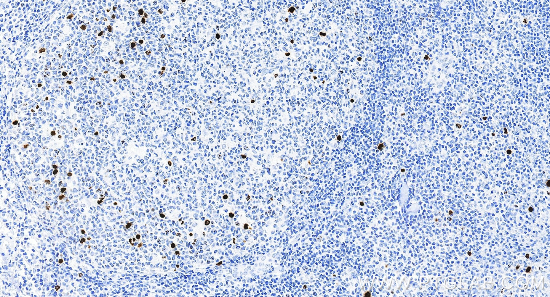 IHC staining of human tonsillitis using 82828-18-RR Immunohistochemistry (IHC) staining of human tonsillitis tissue using Phospho-Histone H3 (Ser10) Recombinant monoclonal (82828-18-RR)