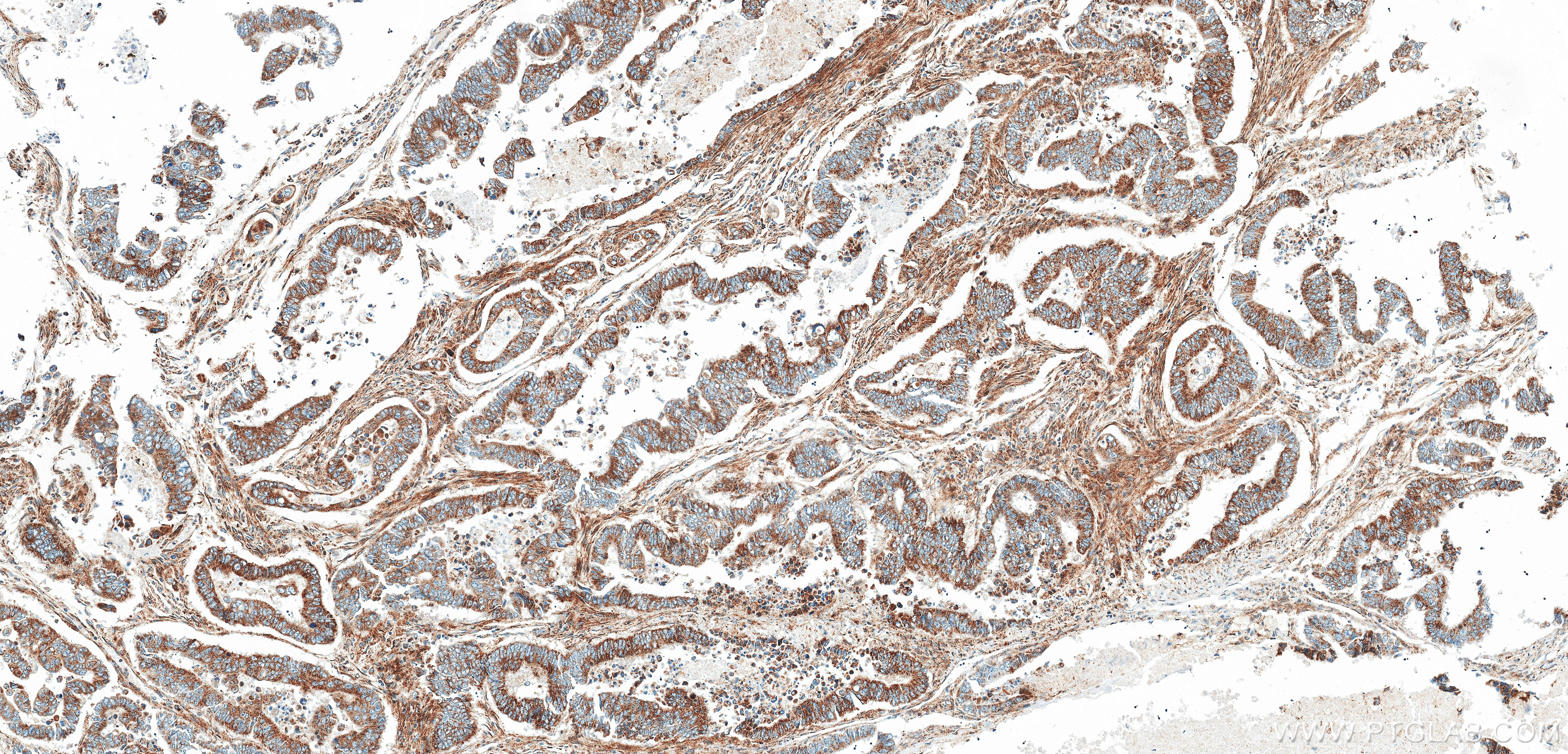Immunohistochemistry (IHC) staining of human colon cancer tissue using Phospho-IRAK4 (Thr345/Ser346) Recombinant monoclon (85753-1-RR)