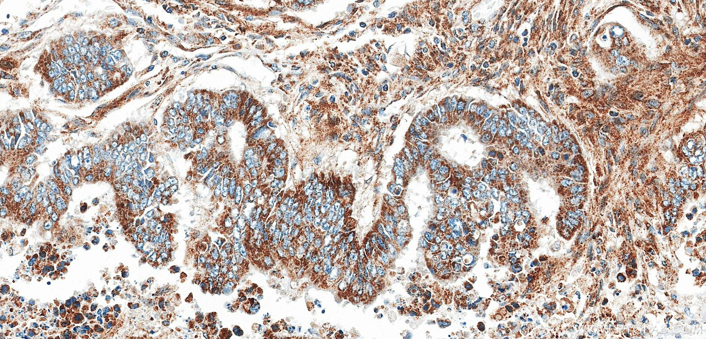 Immunohistochemistry (IHC) staining of human colon cancer tissue using Phospho-IRAK4 (Thr345/Ser346) Recombinant monoclon (85753-1-RR)