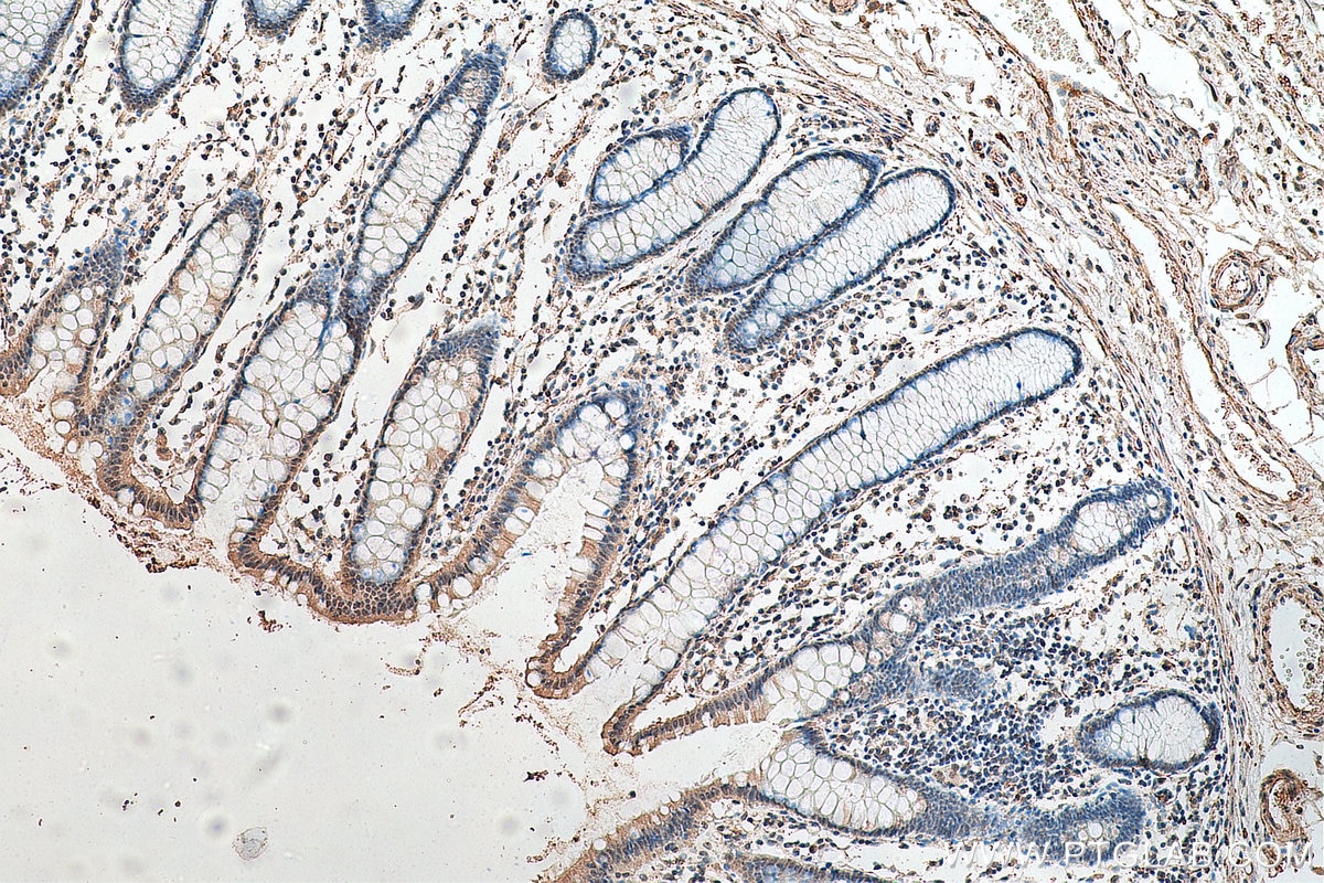 Immunohistochemistry (IHC) staining of human colon cancer tissue using Phospho-P53 (Ser46) Monoclonal antibody (67900-1-Ig)