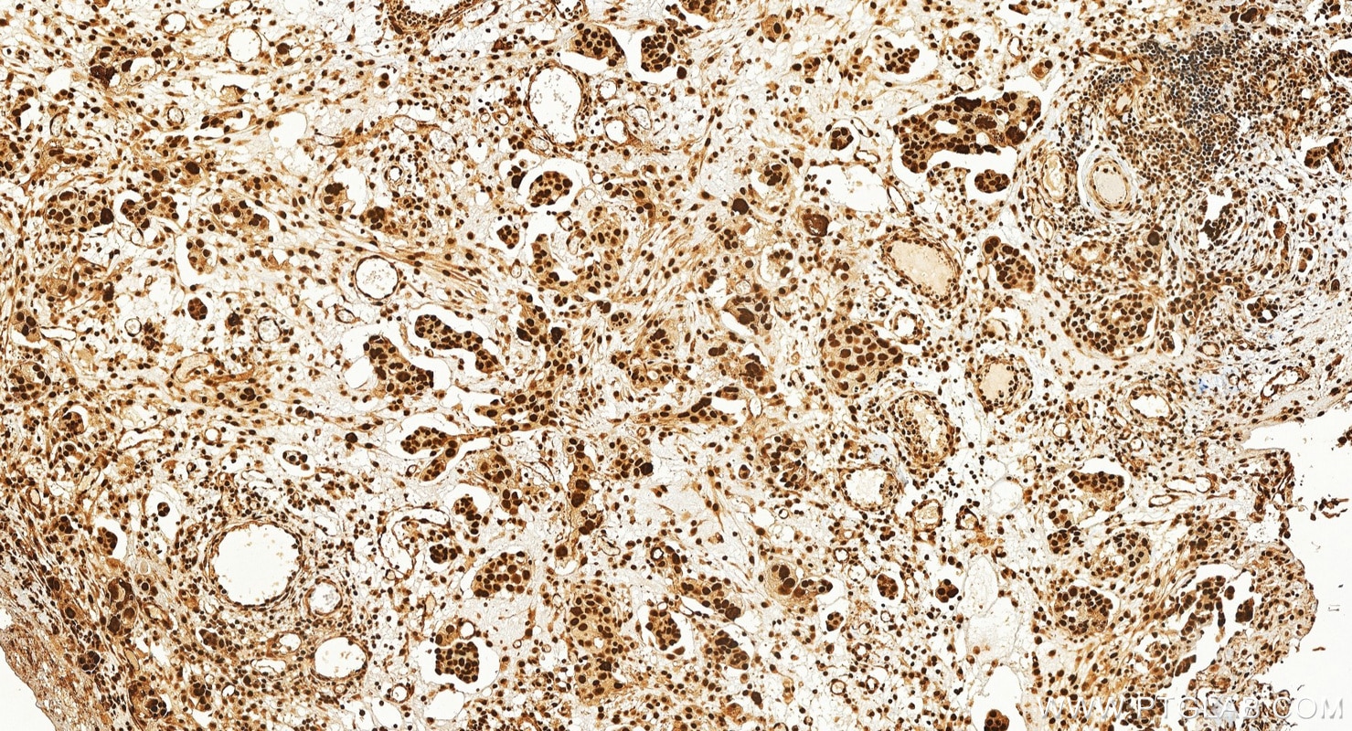 Immunohistochemistry (IHC) staining of human ovary cancer tissue using Phospho-RB1 (Ser807/811) Polyclonal antibody (30376-1-AP)