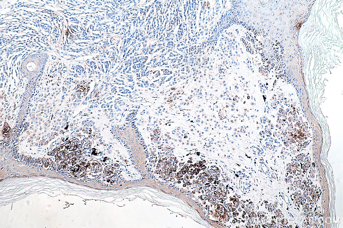 Immunohistochemistry (IHC) staining of human malignant melanoma tissue using Phospho-RPS6KA1 (Ser380) Recombinant antibody (80108-1-RR)