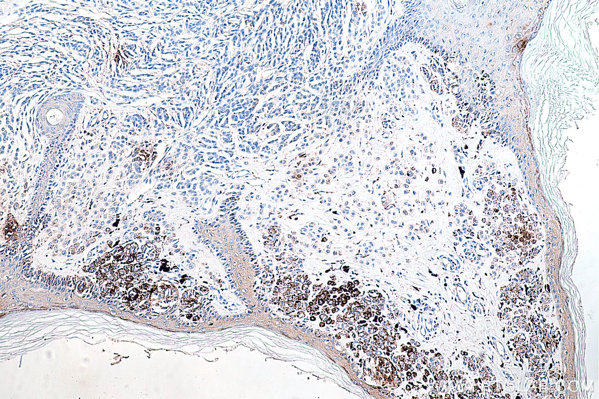 IHC staining of human malignant melanoma using 80108-1-RR