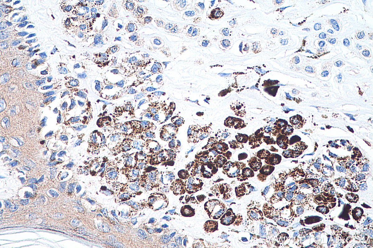 Immunohistochemistry (IHC) staining of human malignant melanoma tissue using Phospho-RPS6KA1 (Ser380) Recombinant antibody (80108-1-RR)