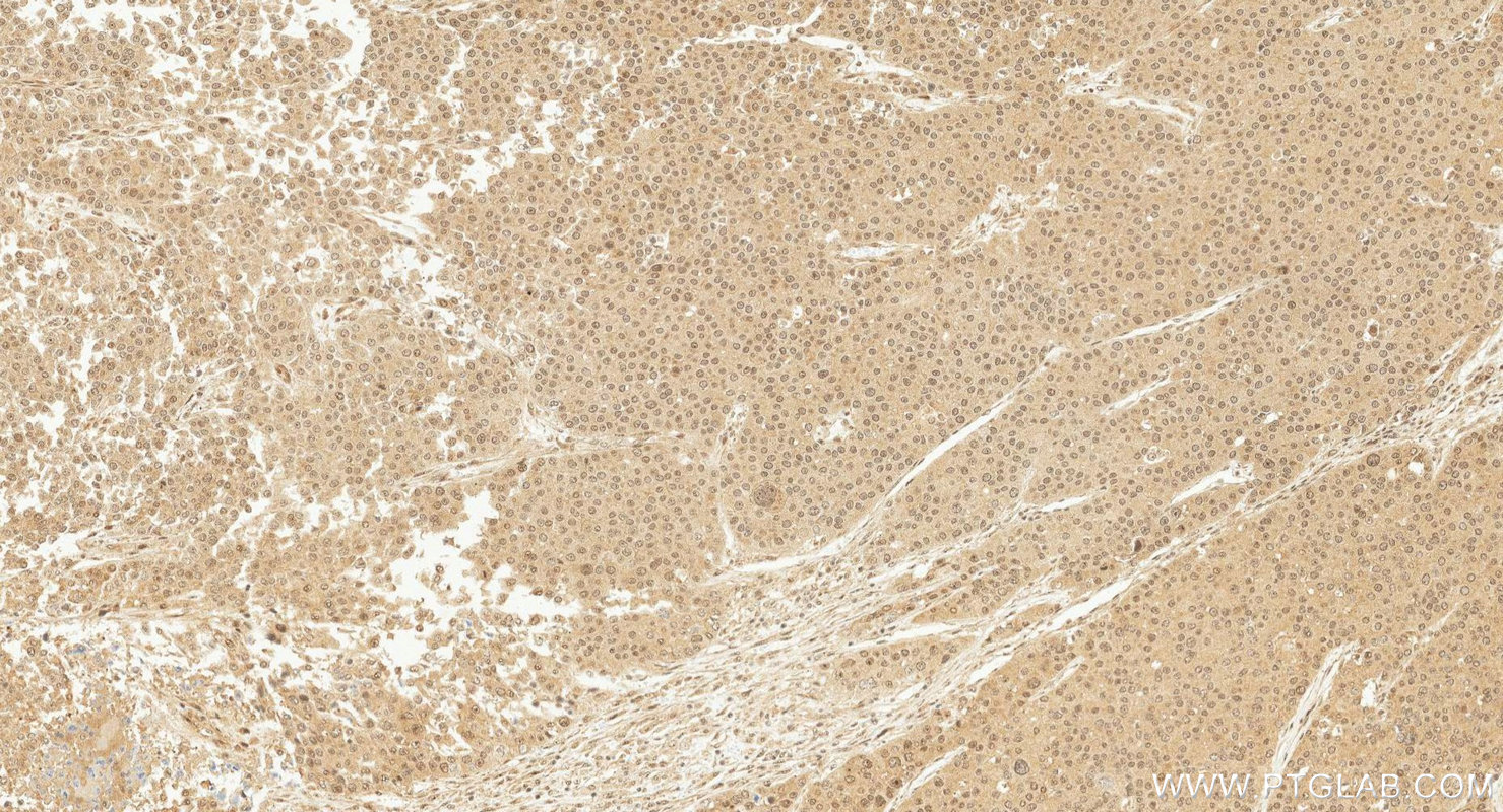 Immunohistochemistry (IHC) staining of human liver cancer tissue using Phospho-SMAD2 (Ser465/467)/SMAD3 (Ser423/425) Reco (80427-2-RR)