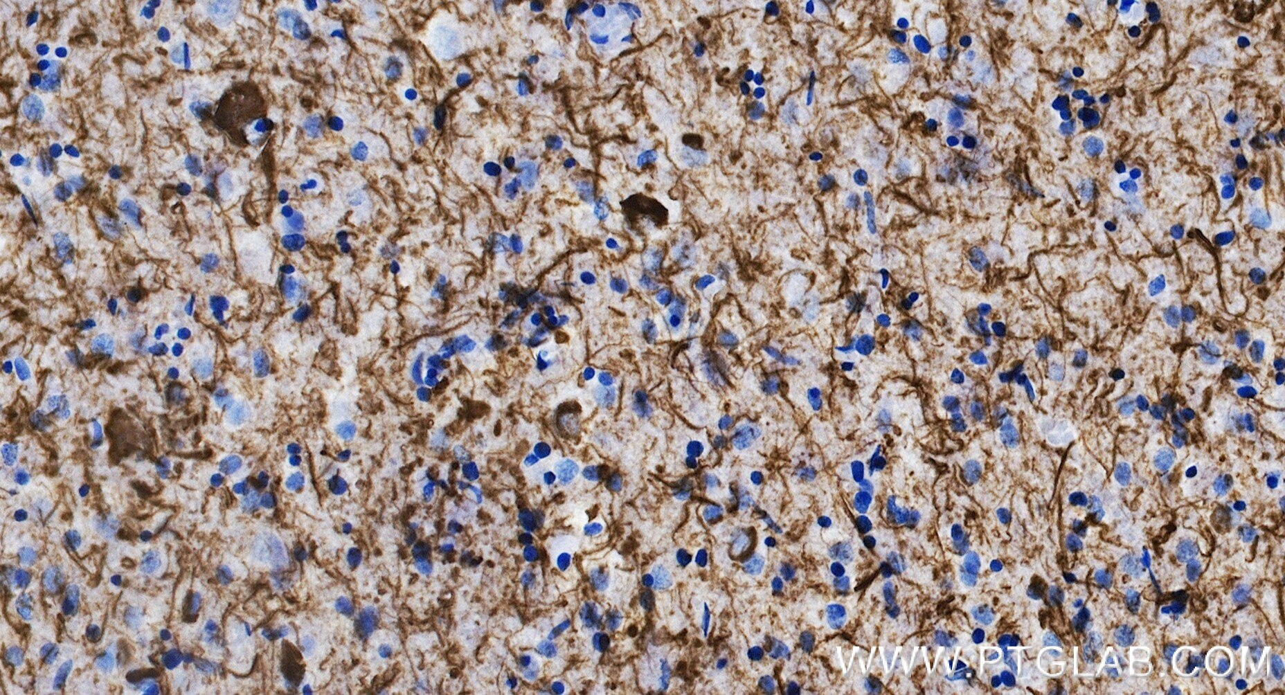IHC staining of human brain(AD) using 80101-7-RR Immunohistochemistry (IHC) staining of human brain(AD) using Phospho-TAU (Thr231) Recombinant monoclonal antibo (80101-7-RR)