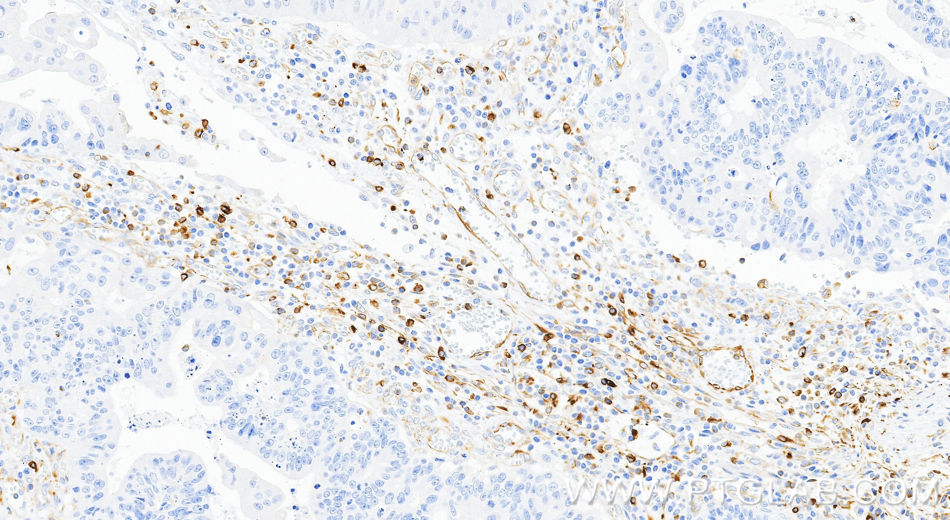 Immunohistochemistry (IHC) staining of human colon cancer tissue using Phospho-Vimentin (Ser39) Recombinant monoclonal an (87714-1-RR)