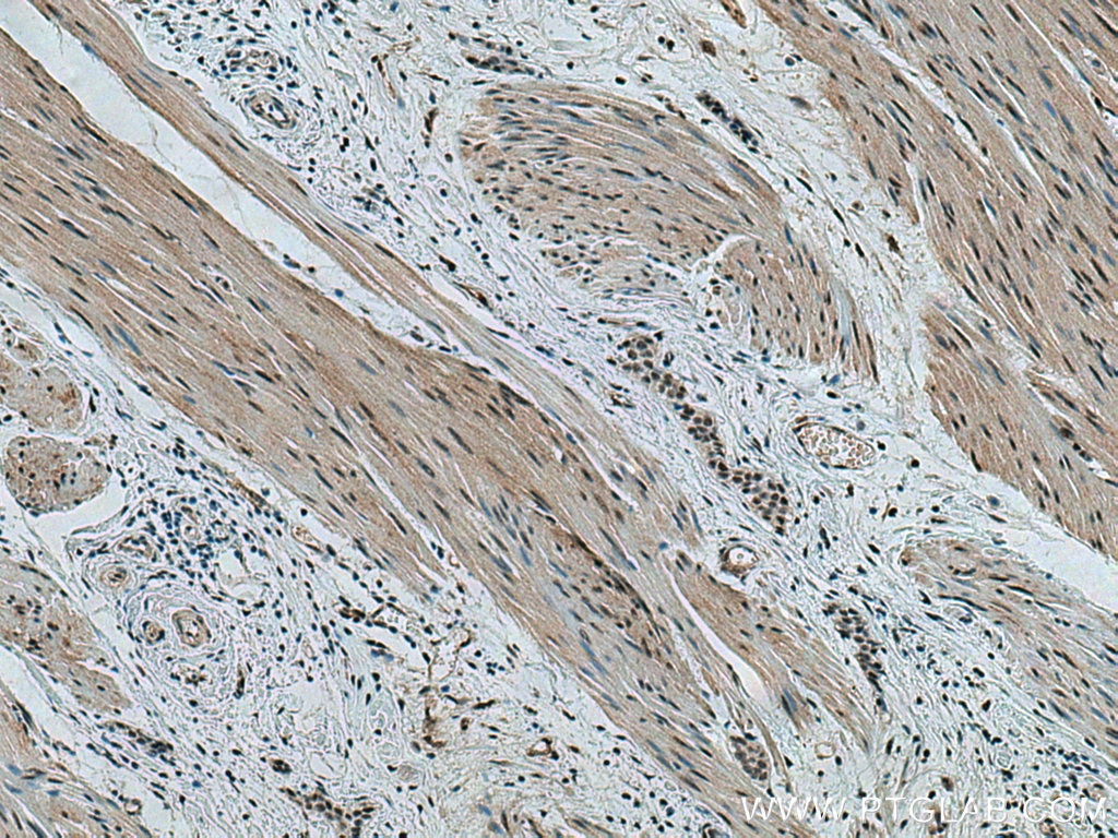 Immunohistochemistry (IHC) staining of human urothelial carcinoma tissue using Phospho-mTOR (Ser2448) Monoclonal antibody (67778-1-Ig)