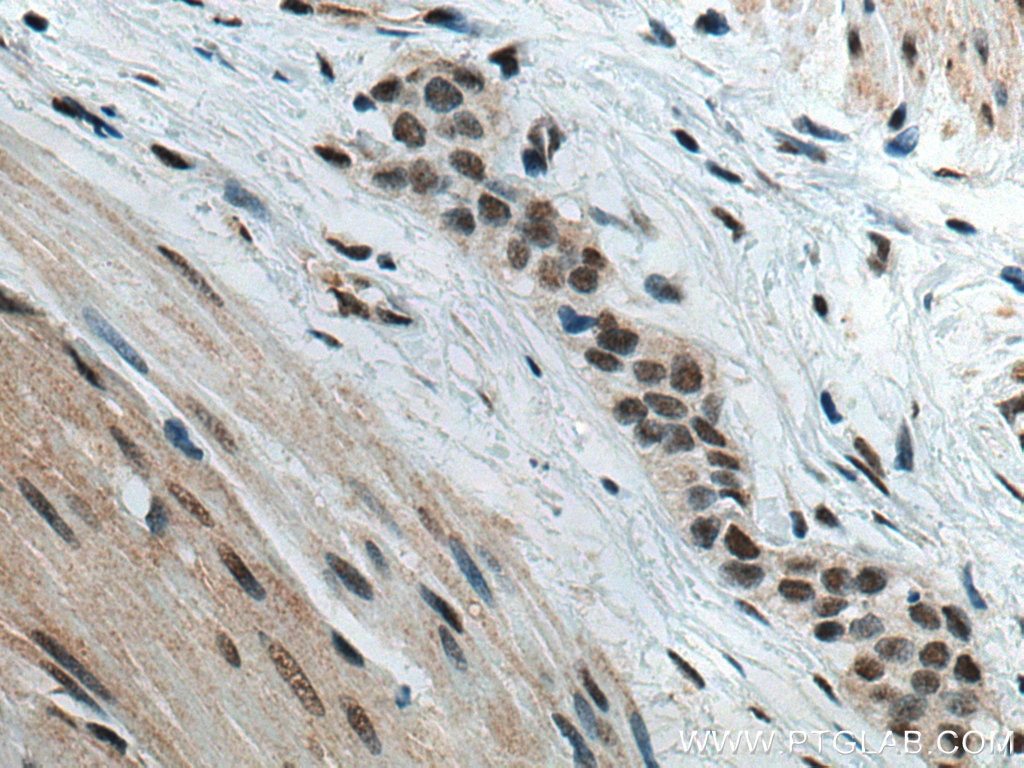 Immunohistochemistry (IHC) staining of human urothelial carcinoma tissue using Phospho-mTOR (Ser2448) Monoclonal antibody (67778-1-Ig)