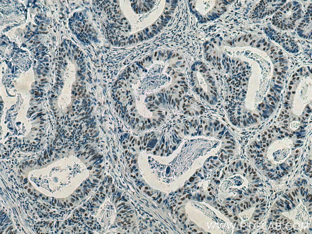 Immunohistochemistry (IHC) staining of human colon cancer tissue using Phospho-mTOR (Ser2448) Monoclonal antibody (67778-1-Ig)