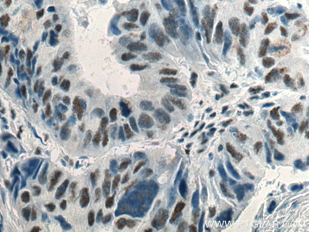 Immunohistochemistry (IHC) staining of human colon cancer tissue using Phospho-mTOR (Ser2448) Monoclonal antibody (67778-1-Ig)