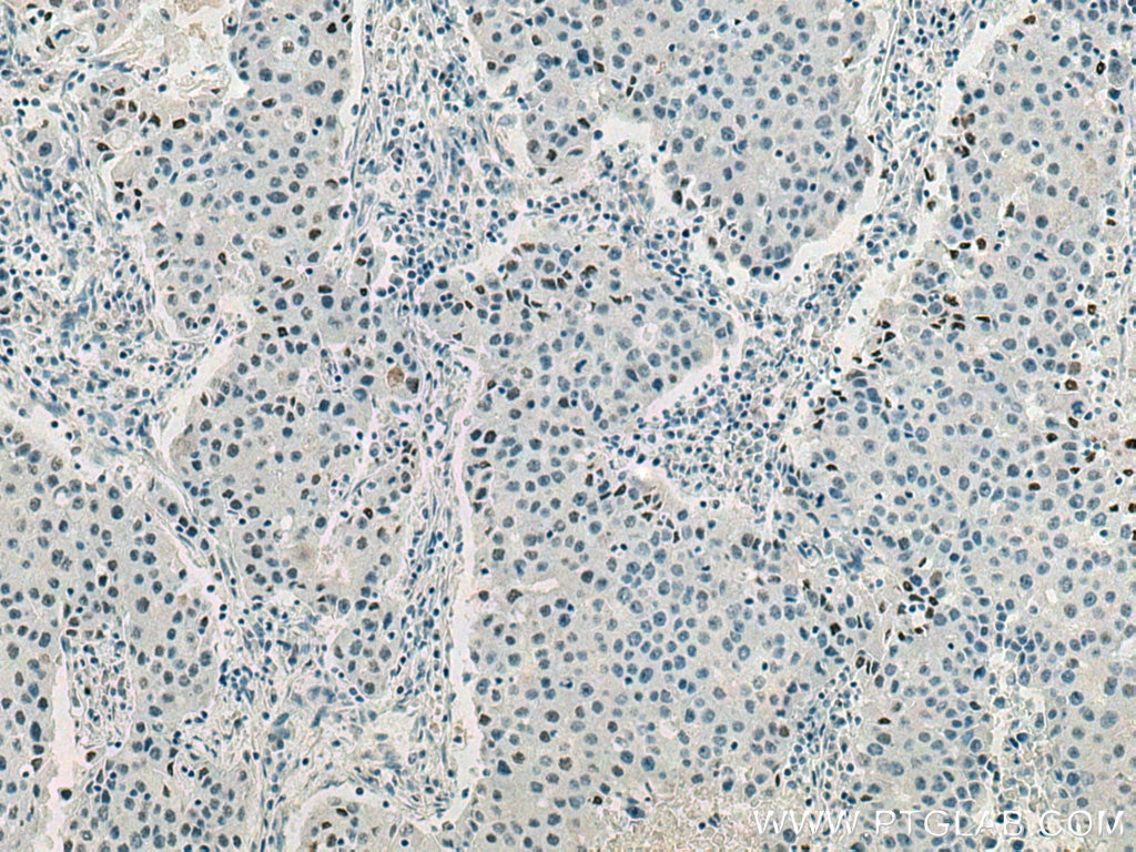 Immunohistochemistry (IHC) staining of human breast cancer tissue using Phospho-mTOR (Ser2448) Monoclonal antibody (67778-1-Ig)