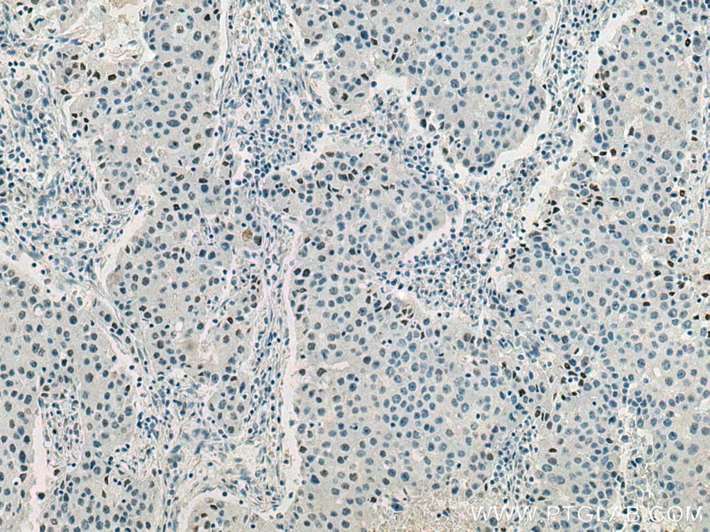 IHC staining of human breast cancer using 67778-1-Ig