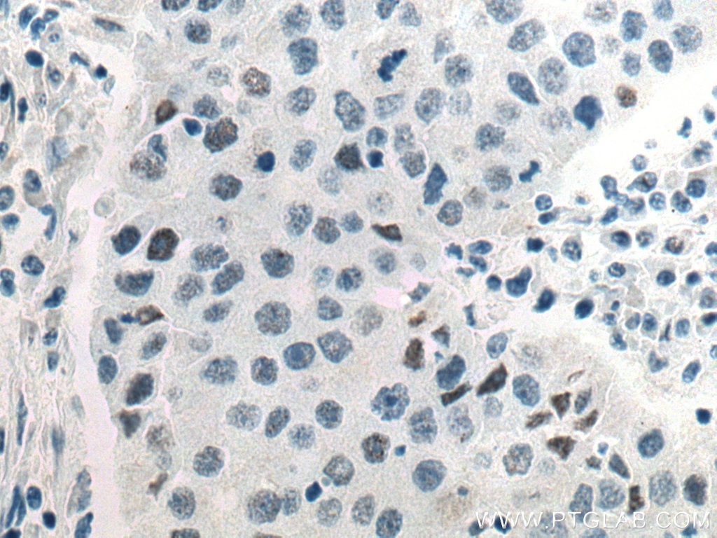 Immunohistochemistry (IHC) staining of human breast cancer tissue using Phospho-mTOR (Ser2448) Monoclonal antibody (67778-1-Ig)