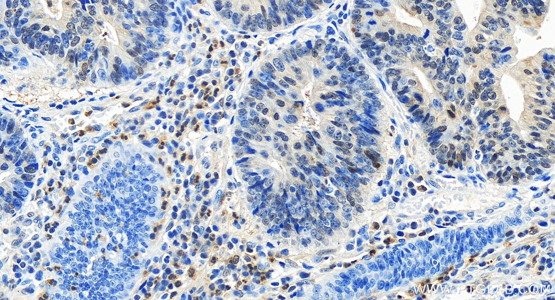 Immunohistochemistry (IHC) staining of human colon cancer tissue using Phospho-p38 MAPK (Thr180/Tyr182) Recombinant antib (81212-2-RR)