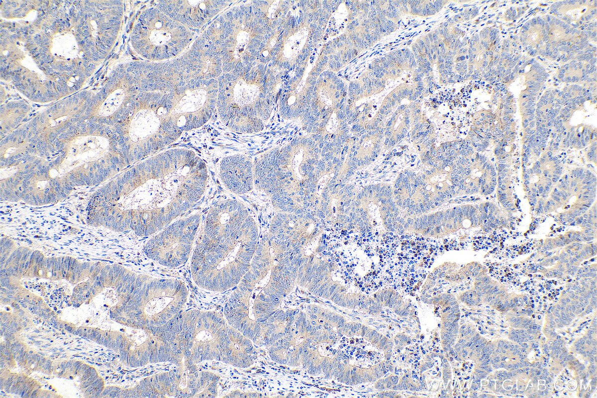 Immunohistochemistry (IHC) staining of human colon cancer tissue using Phospholipase C epsilon 1 Polyclonal antibody (55463-1-AP)