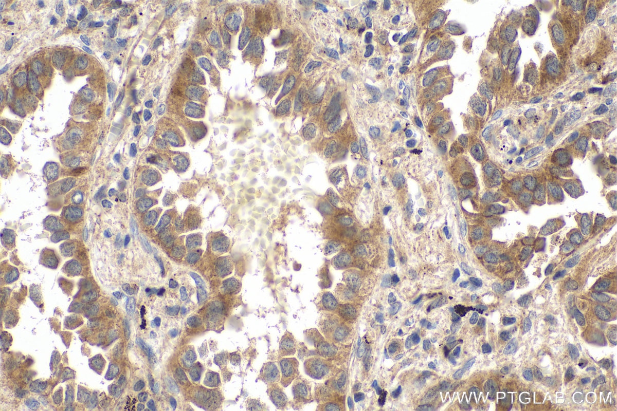 Immunohistochemistry (IHC) staining of human lung cancer tissue using Phospholipase C epsilon 1 Polyclonal antibody (55463-1-AP)