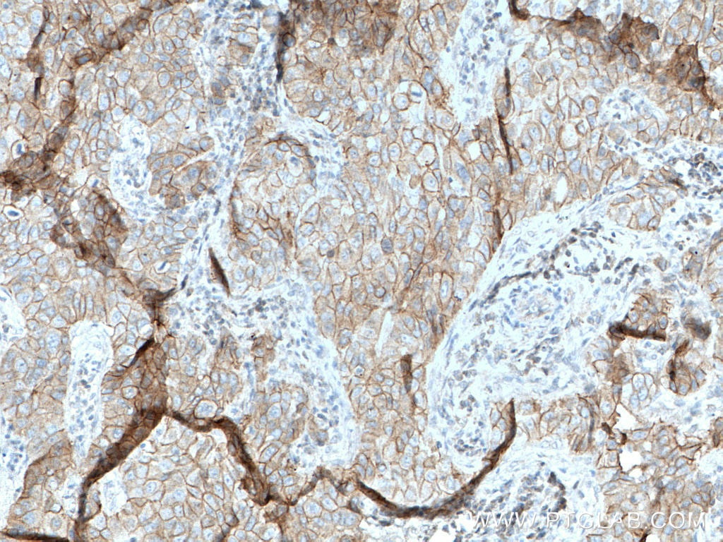 Immunohistochemistry (IHC) staining of human breast cancer tissue using Gamma Catenin Monoclonal antibody (66445-1-Ig)