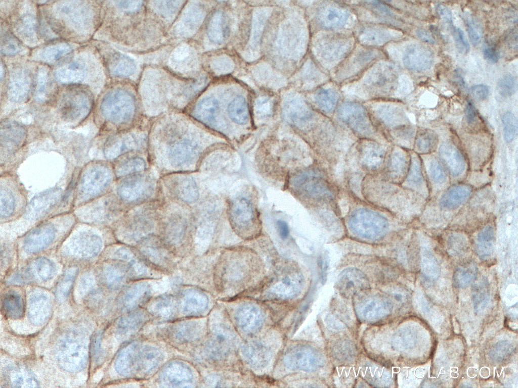 Immunohistochemistry (IHC) staining of human breast cancer tissue using Gamma Catenin Monoclonal antibody (66445-1-Ig)