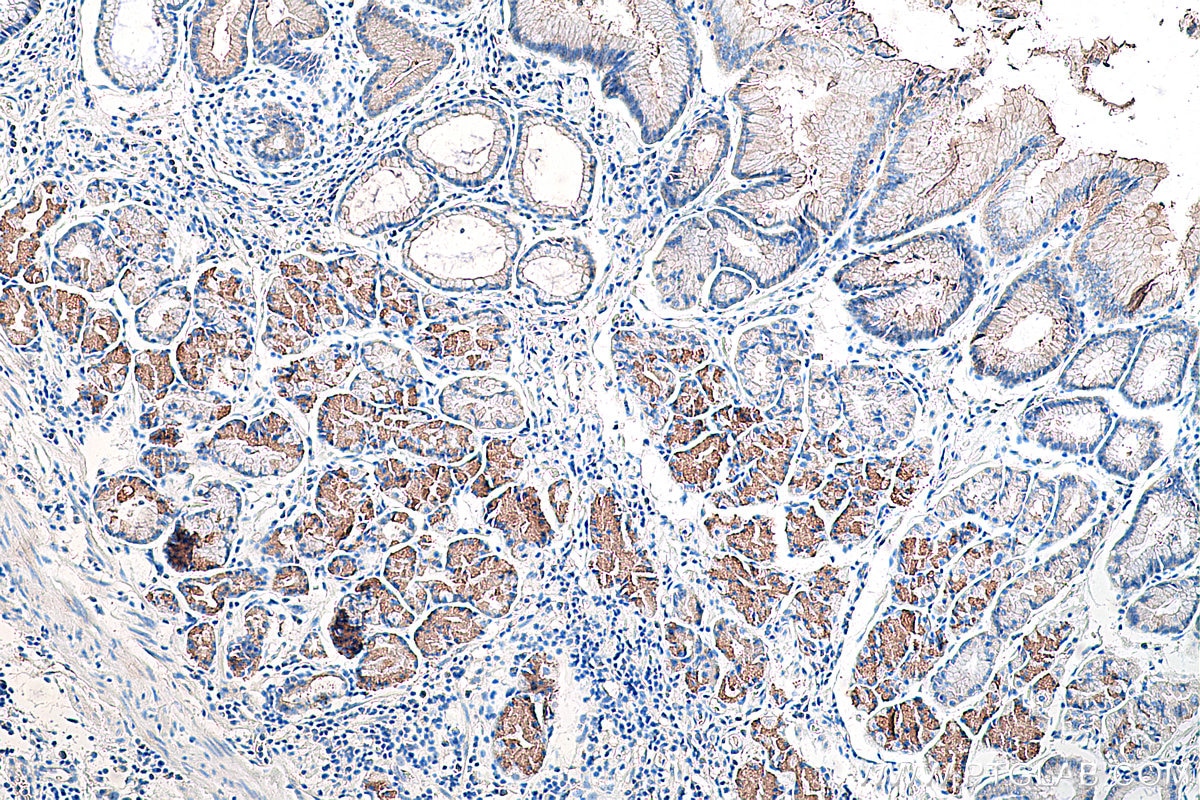 Immunohistochemistry (IHC) staining of human stomach cancer tissue using Gamma Catenin Monoclonal antibody (66445-1-Ig)
