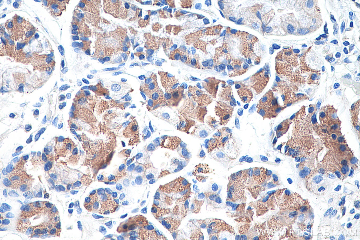 Immunohistochemistry (IHC) staining of human stomach cancer tissue using Gamma Catenin Monoclonal antibody (66445-1-Ig)