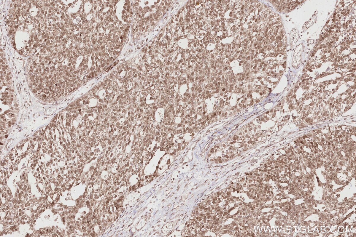 Immunohistochemistry (IHC) staining of human ovary cancer tissue using Plakophilin 2 Polyclonal antibody (26479-1-AP)