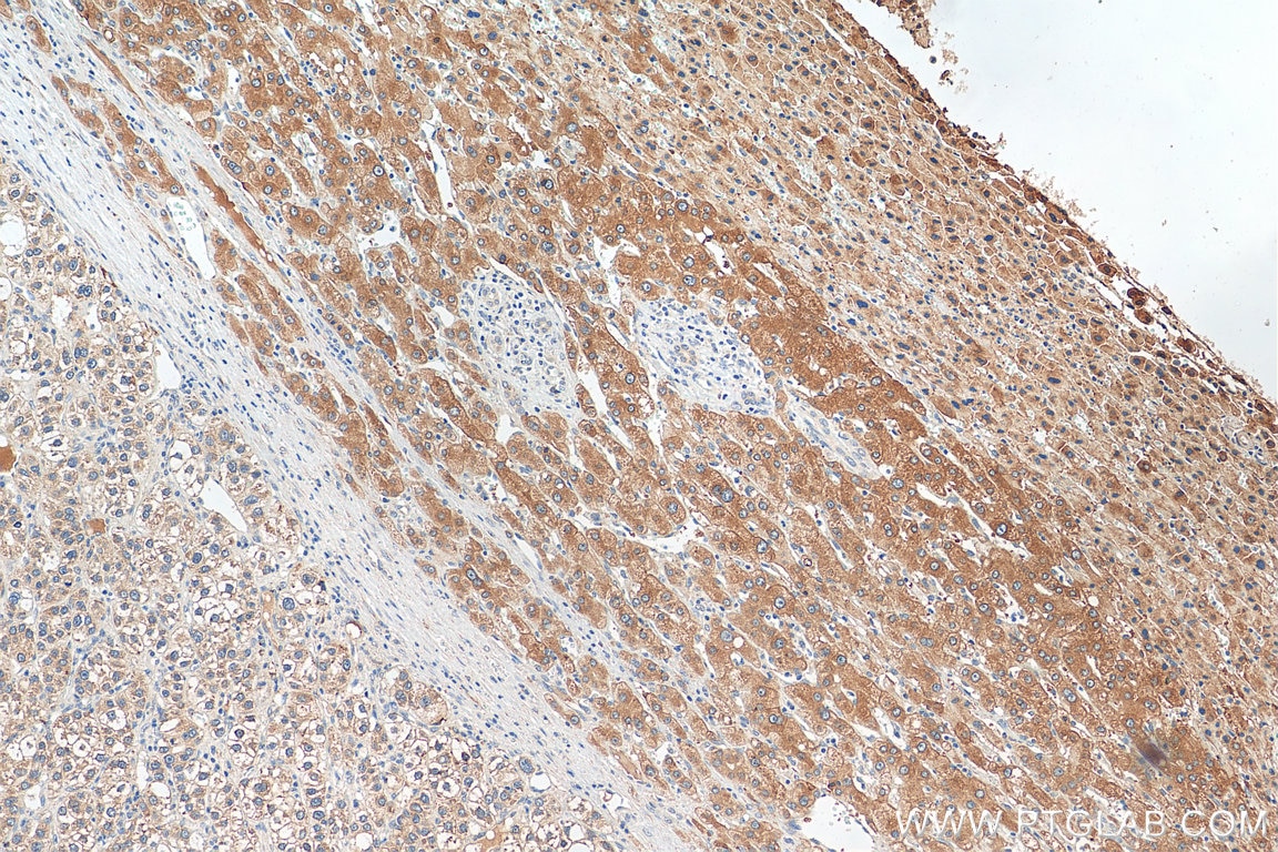 Immunohistochemistry (IHC) staining of human liver cancer tissue using Plasminogen Polyclonal antibody (26768-1-AP)