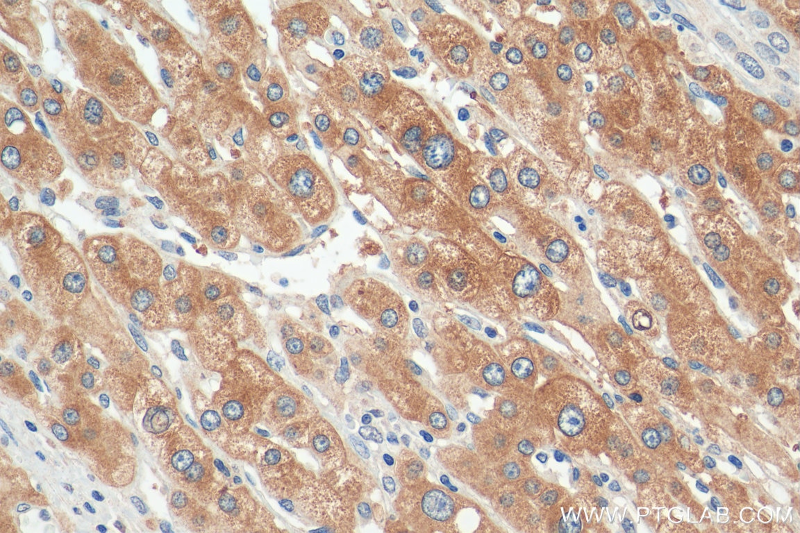 Immunohistochemistry (IHC) staining of human liver cancer tissue using Plasminogen Polyclonal antibody (26768-1-AP)