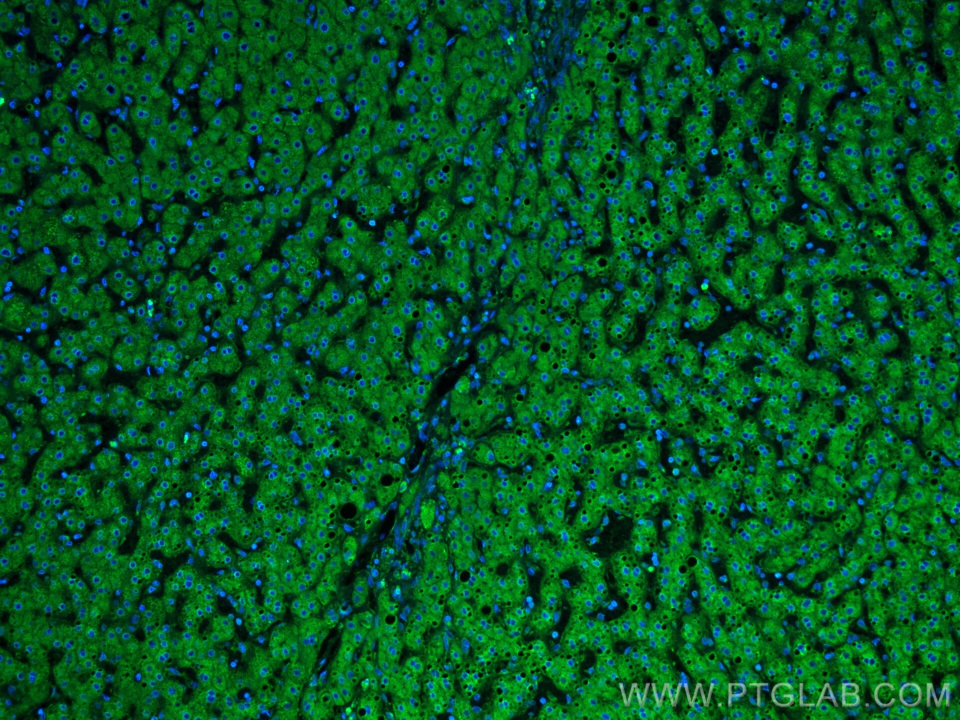 Immunofluorescence (IF) / fluorescent staining of human liver cancer tissue using CoraLite® Plus 488-conjugated Plasminogen Monoclon (CL488-66399)