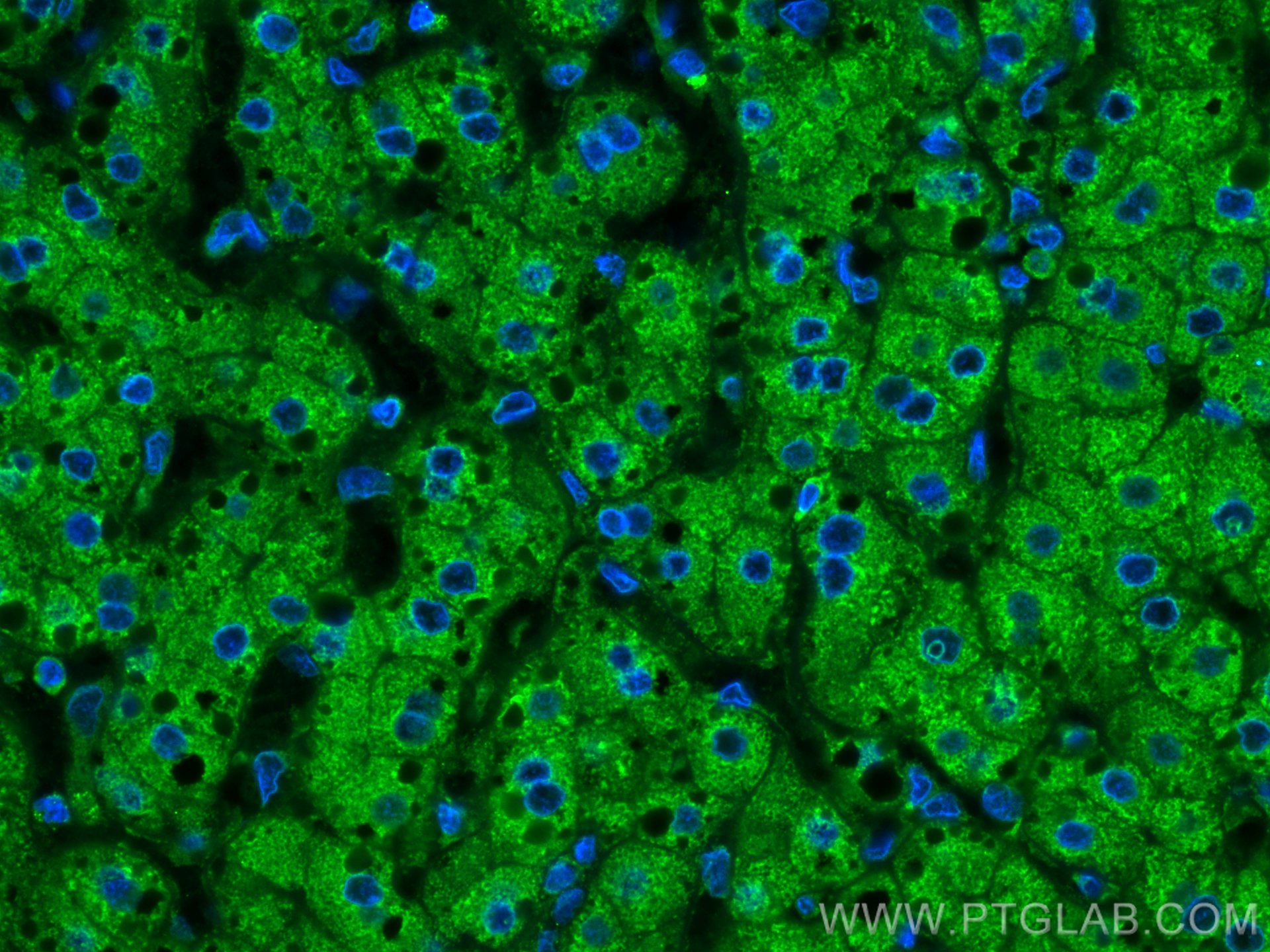 Immunofluorescence (IF) / fluorescent staining of human liver cancer tissue using CoraLite® Plus 488-conjugated Plasminogen Monoclon (CL488-66399)