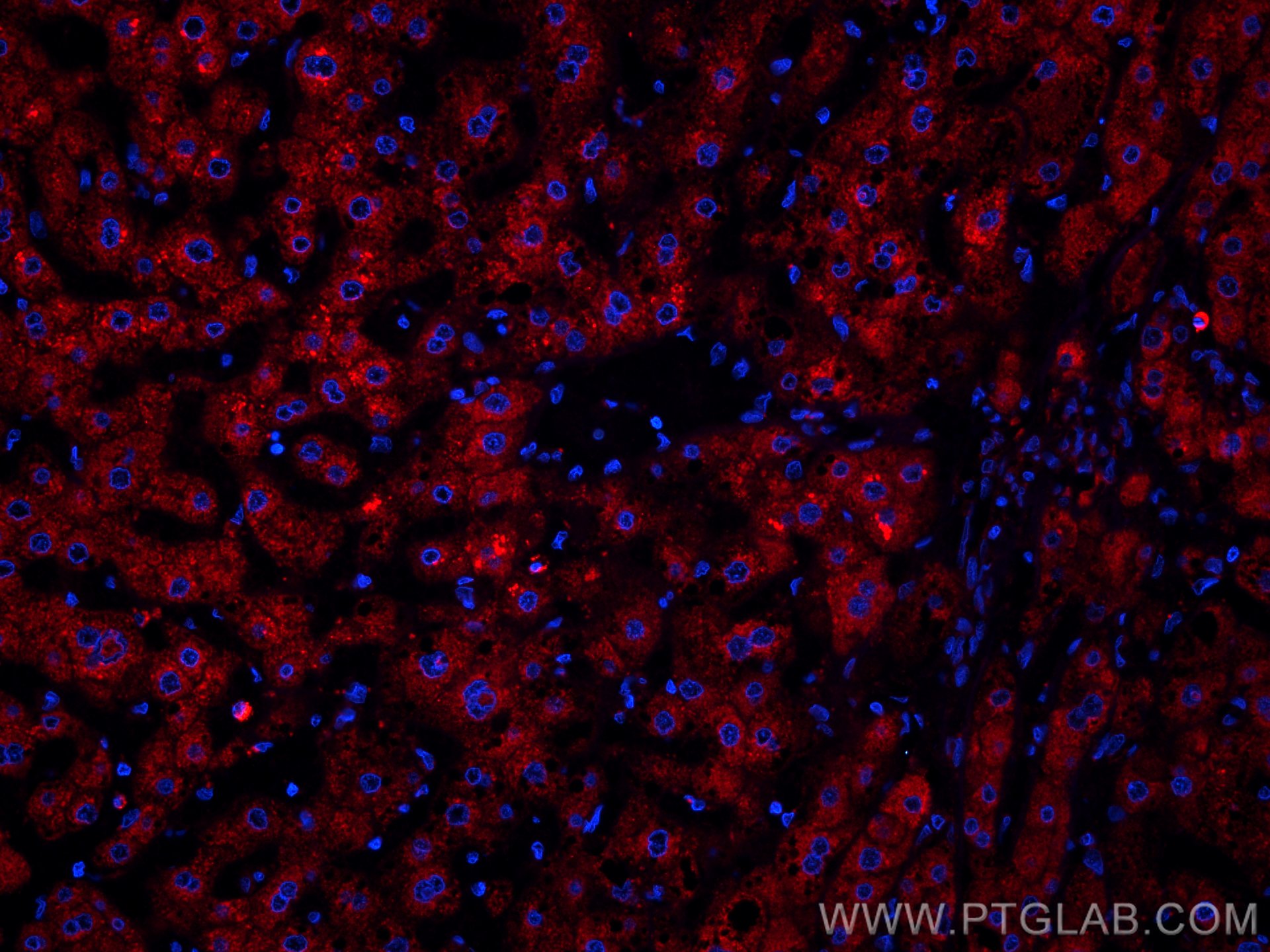 Immunofluorescence (IF) / fluorescent staining of human liver cancer tissue using CoraLite®594-conjugated Plasminogen Monoclonal ant (CL594-66399)