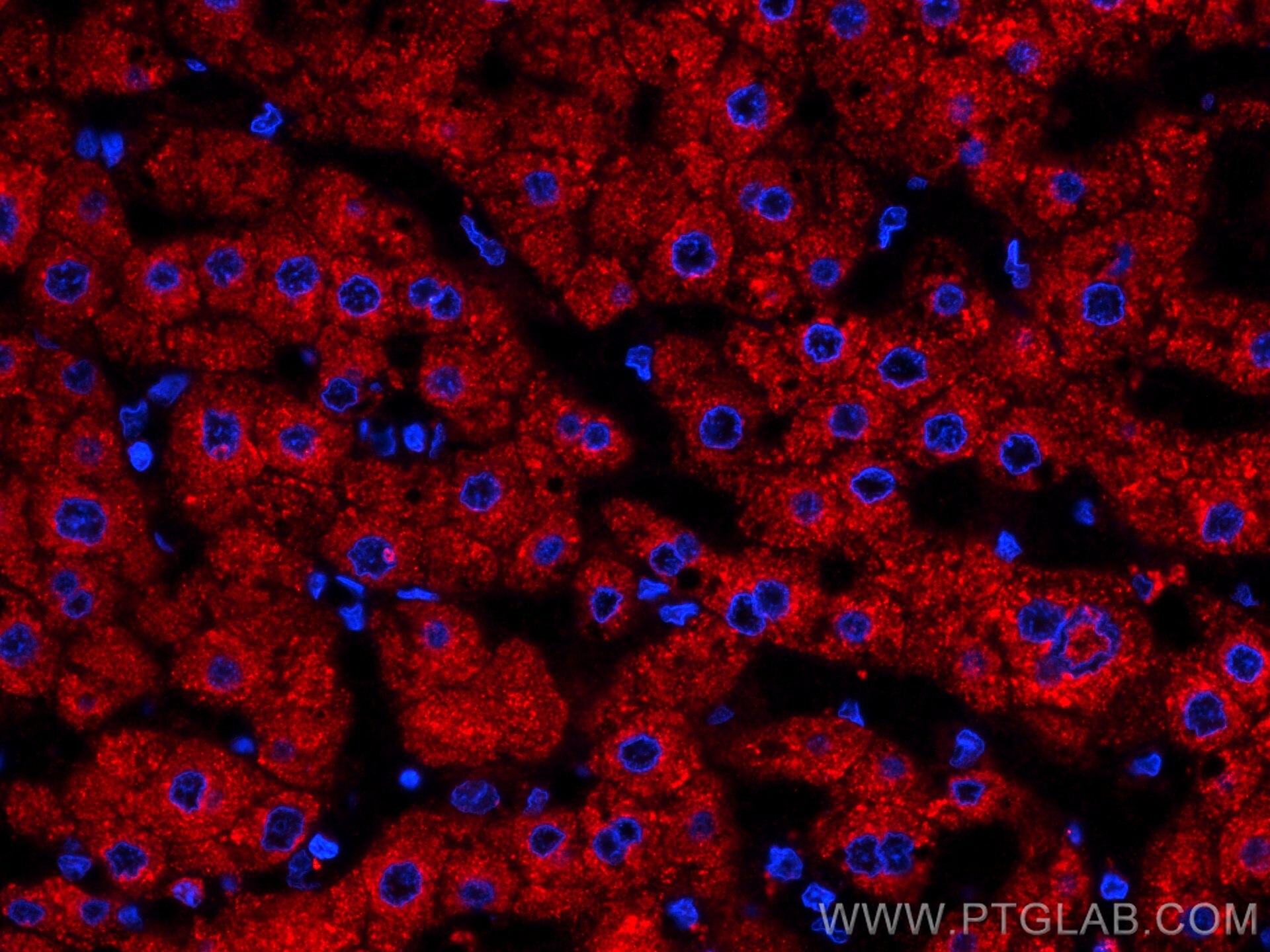 Immunofluorescence (IF) / fluorescent staining of human liver cancer tissue using CoraLite®594-conjugated Plasminogen Monoclonal ant (CL594-66399)